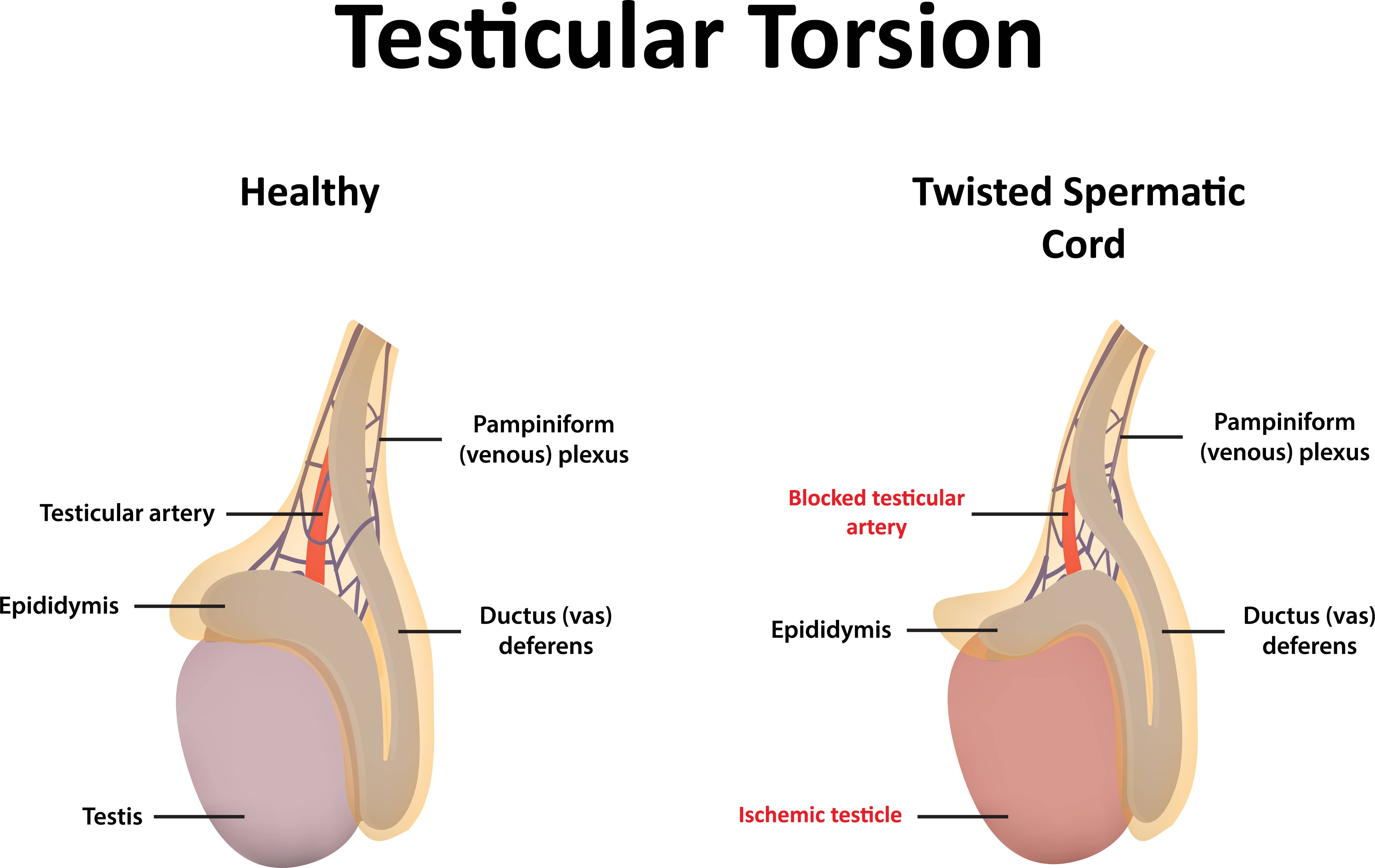 pediatric-urology-torsion-testis.html