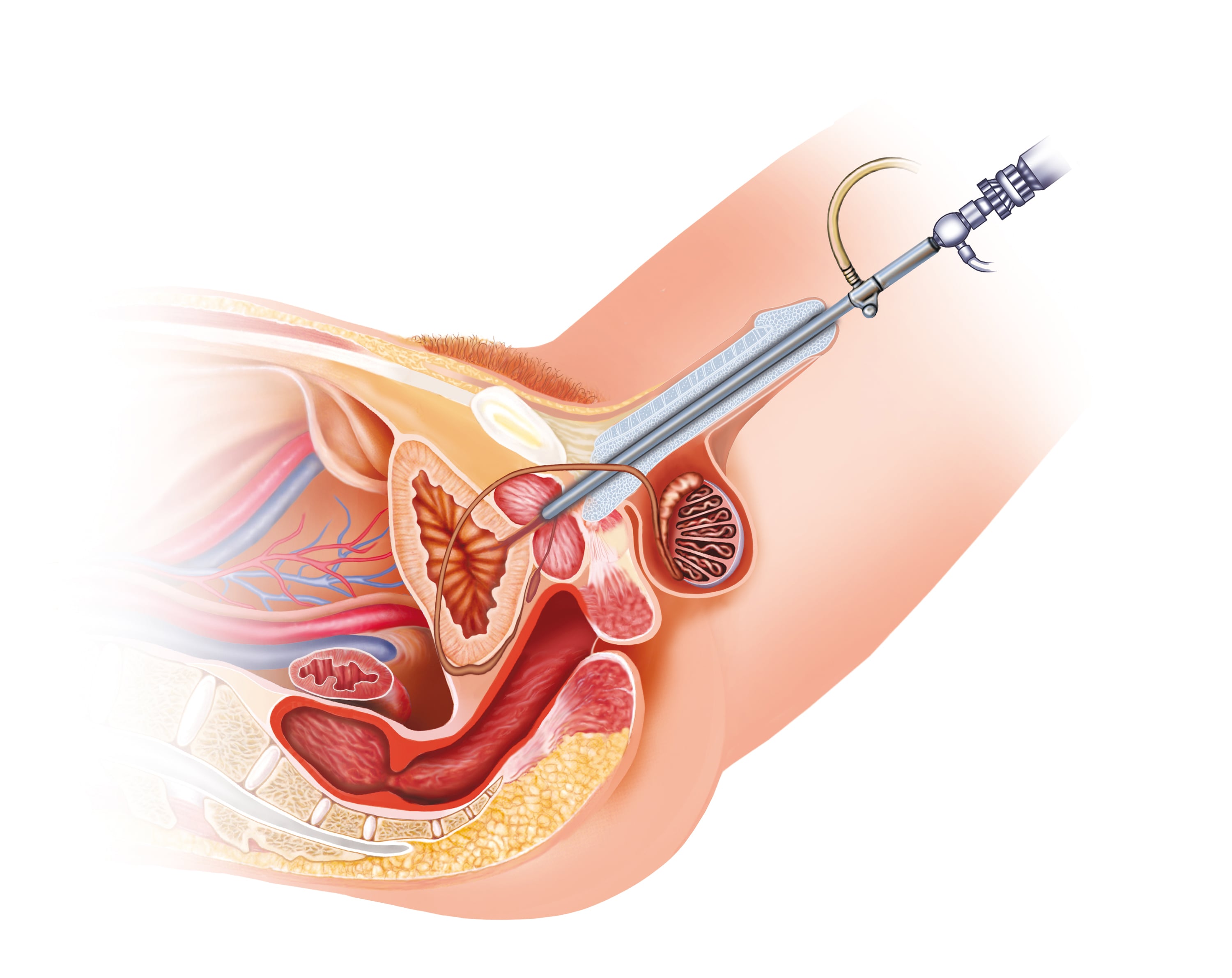 narrowing of the urethra treatment